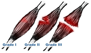 musle strain