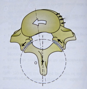 rotated vertebra